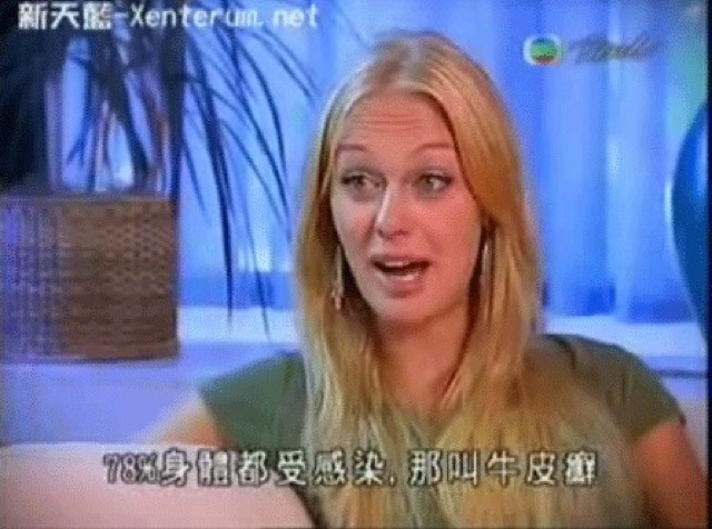 78%身體都受感染，那叫牛皮癬